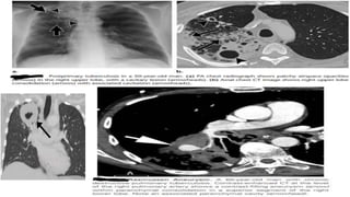Imaging of pulmonary infections | PPTX