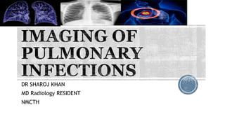 DR SHAROJ KHAN
MD Radiology RESIDENT
NMCTH
 