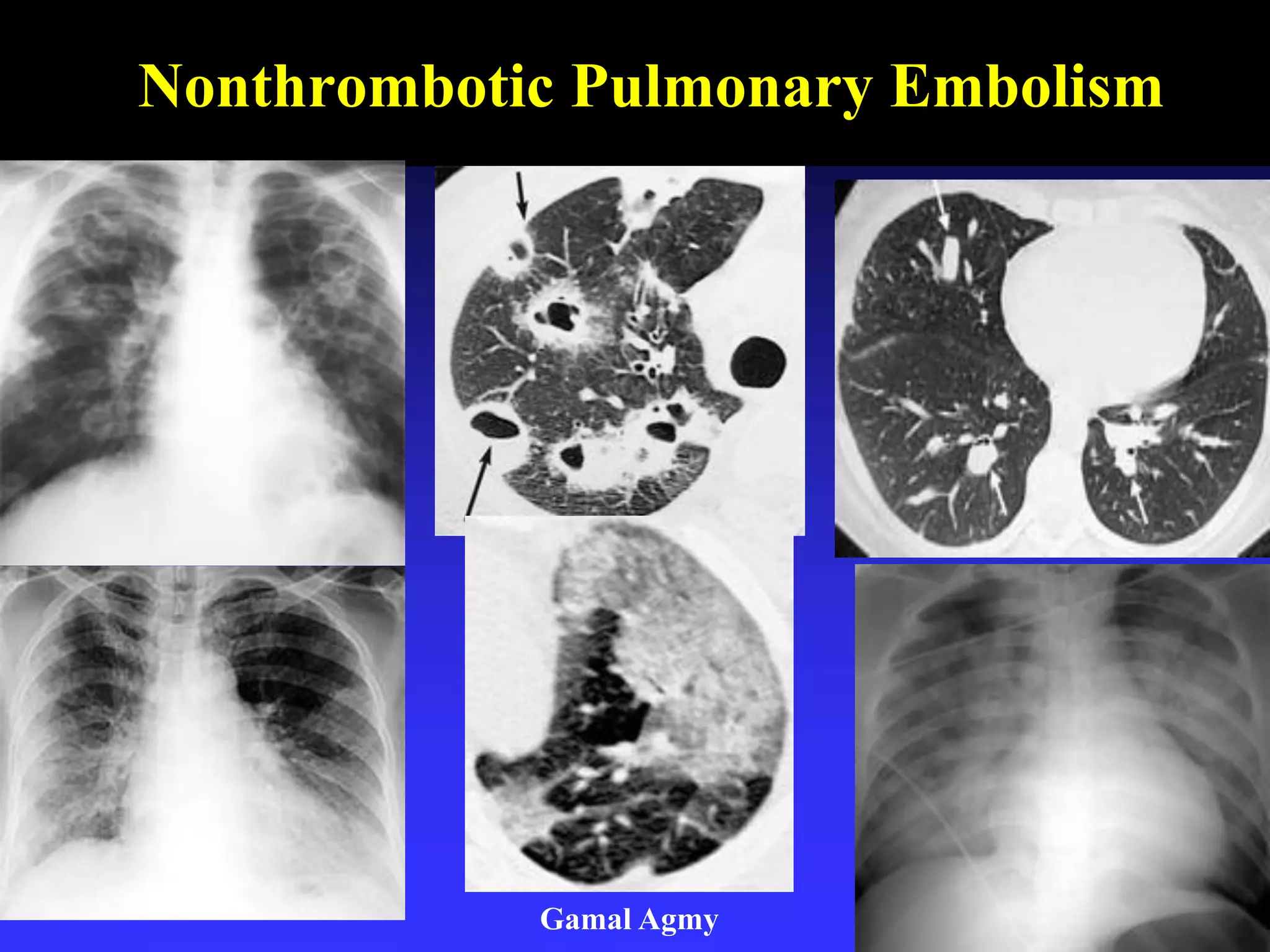 Nonthrombotic Pulmonary Embolism
Gamal Agmy
 