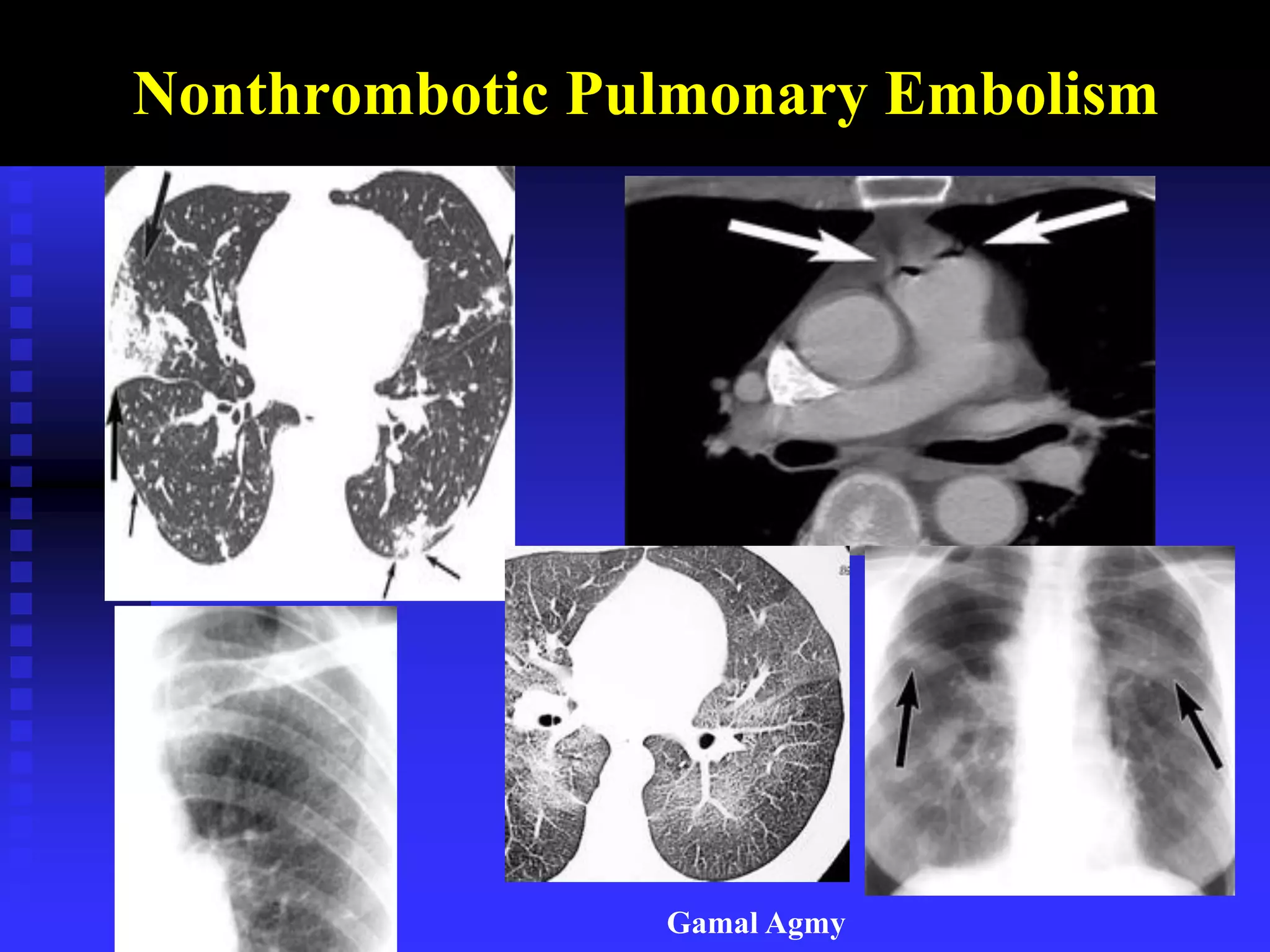 Nonthrombotic Pulmonary Embolism
Gamal Agmy
 