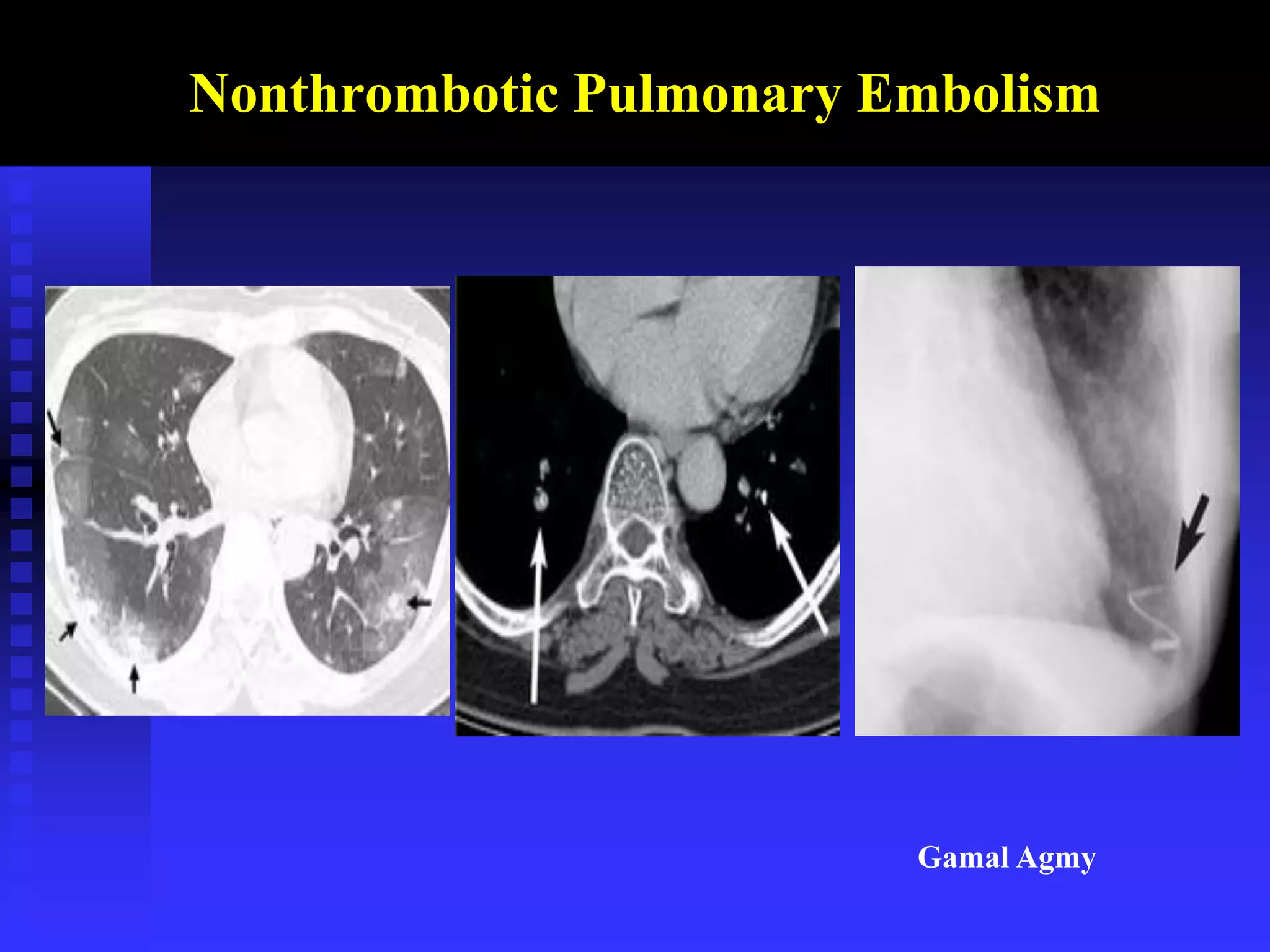 Nonthrombotic Pulmonary Embolism
Gamal Agmy
 