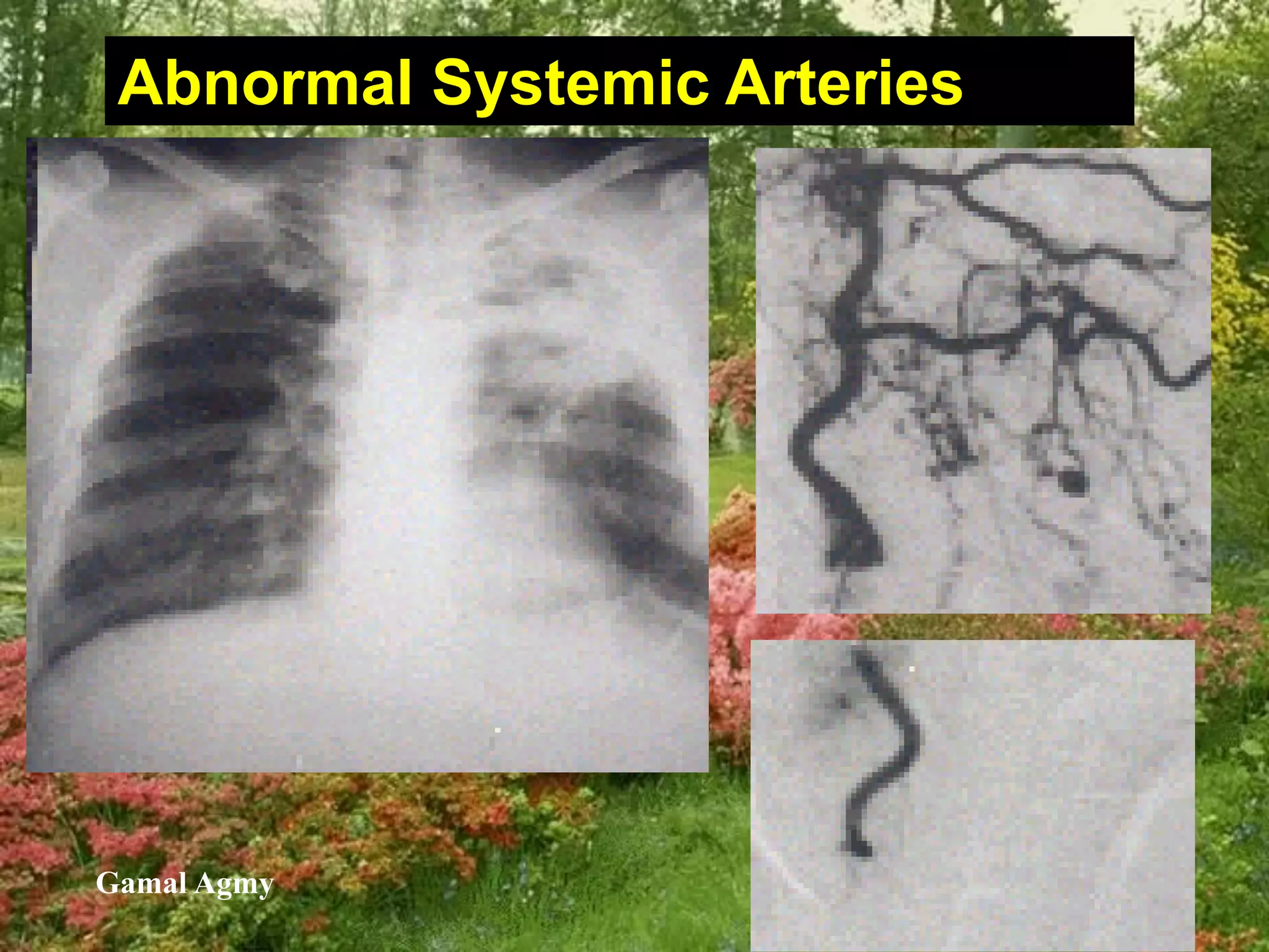 Abnormal Systemic Arteries
Gamal Agmy
 