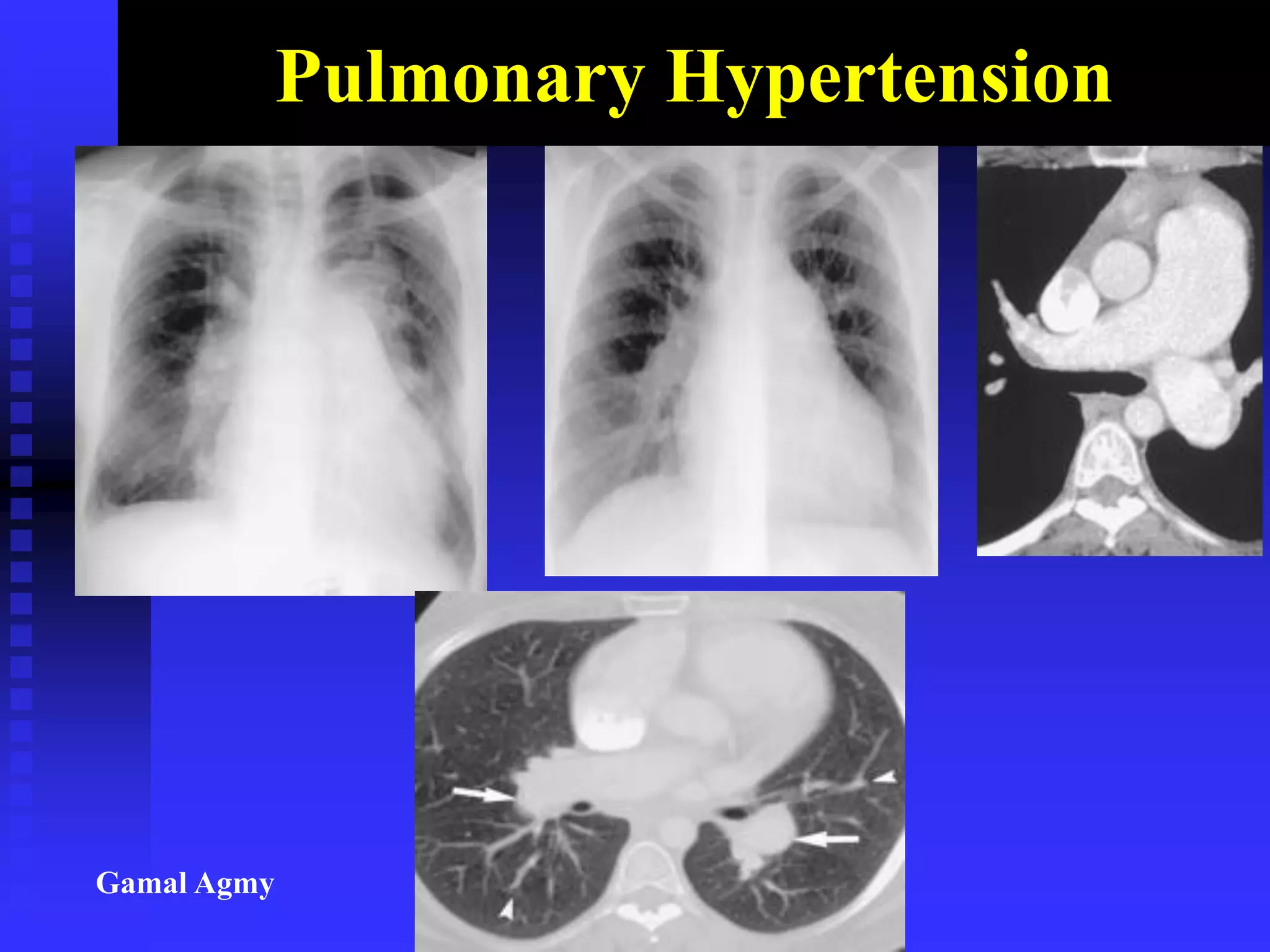 Pulmonary Hypertension
Gamal Agmy
 