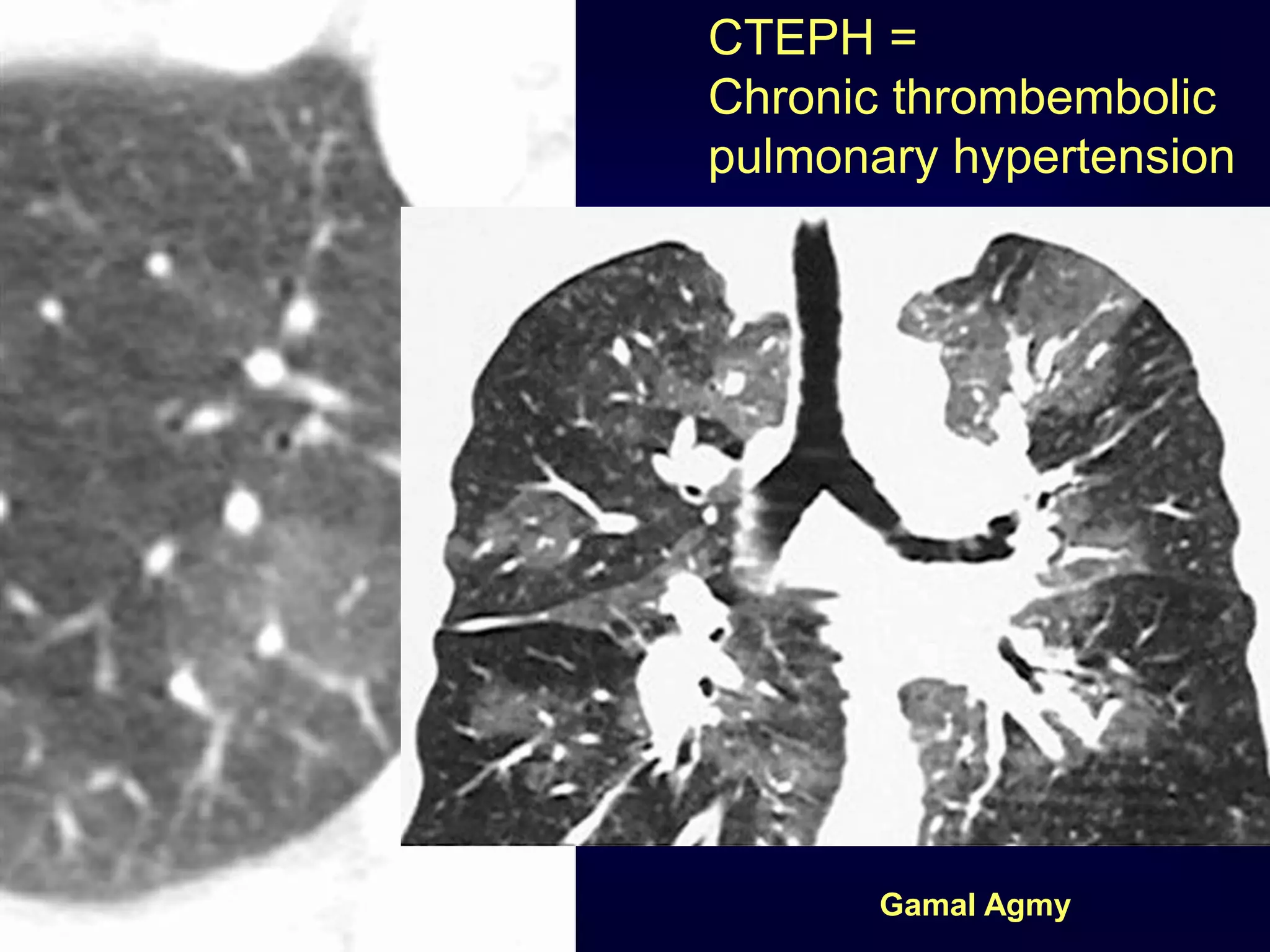CTEPH =
Chronic thrombembolic
pulmonary hypertension
Gamal Agmy
 