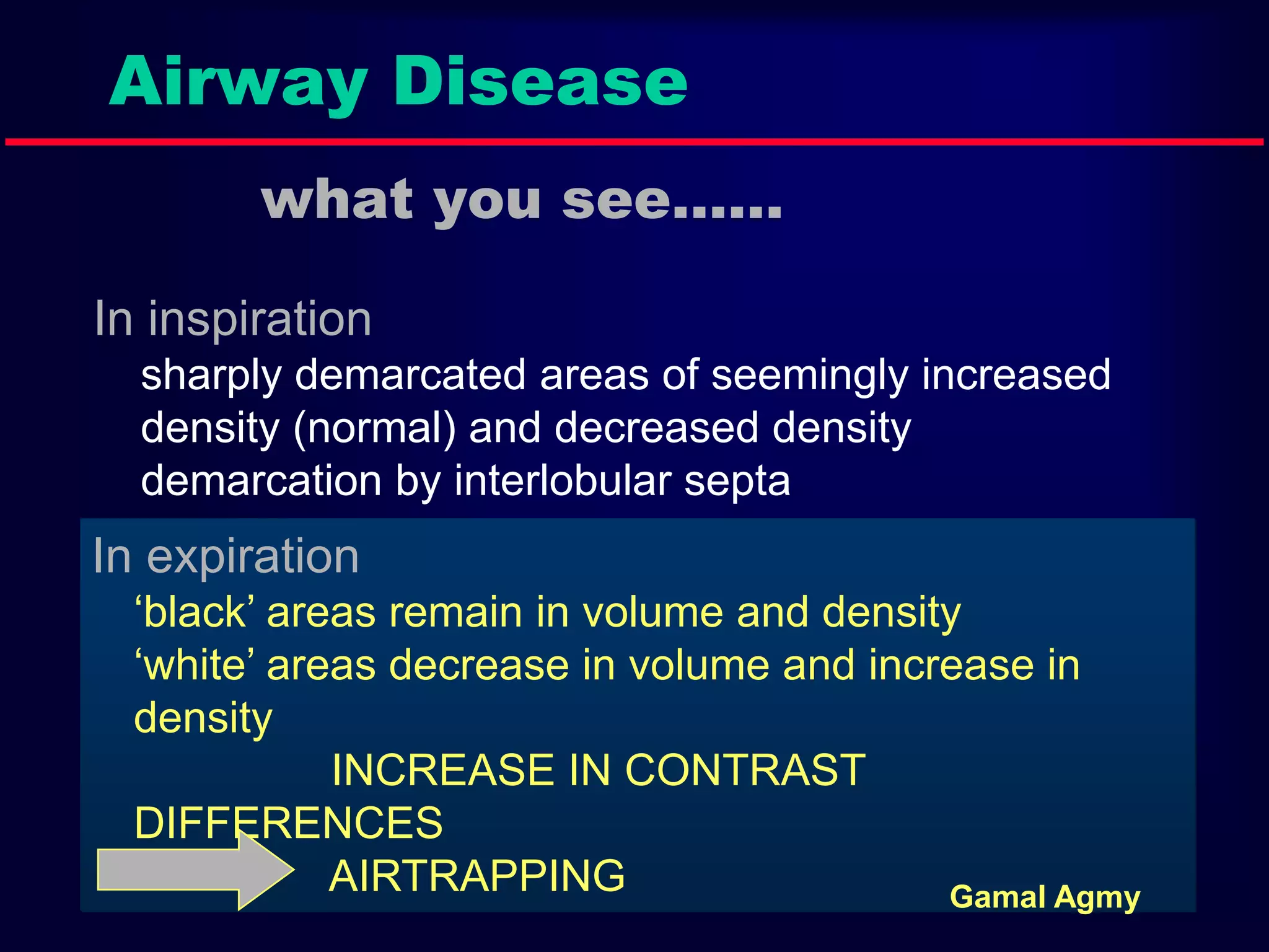 Airway Disease
what you see……
In inspiration
sharply demarcated areas of seemingly increased
density (normal) and decreased density
demarcation by interlobular septa
In expiration
‘black’ areas remain in volume and density
‘white’ areas decrease in volume and increase in
density
INCREASE IN CONTRAST
DIFFERENCES
AIRTRAPPING Gamal Agmy
 