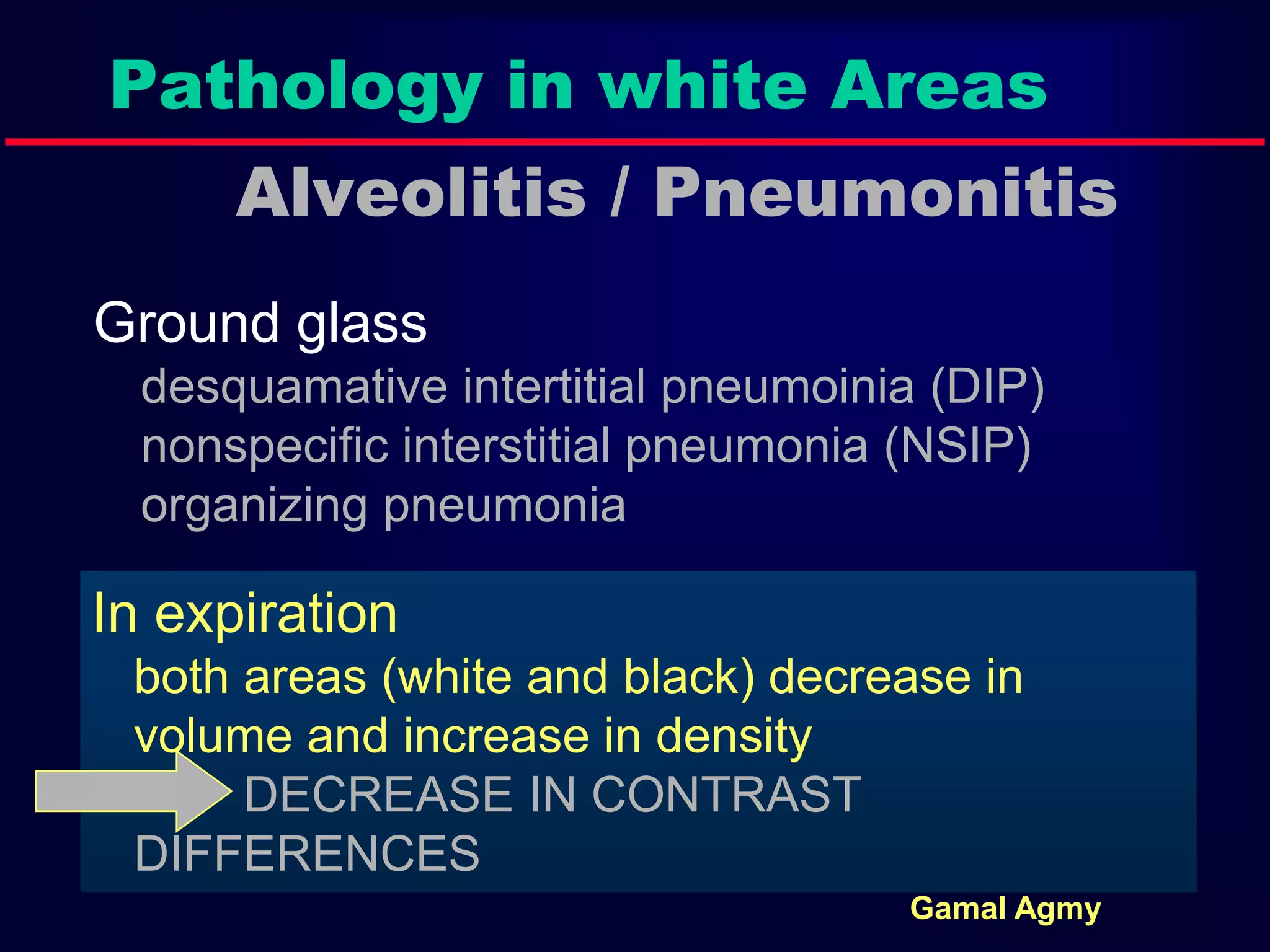 Pathology in white Areas
Alveolitis / Pneumonitis
Ground glass
desquamative intertitial pneumoinia (DIP)
nonspecific interstitial pneumonia (NSIP)
organizing pneumonia
In expiration
both areas (white and black) decrease in
volume and increase in density
DECREASE IN CONTRAST
DIFFERENCES
Gamal Agmy
 