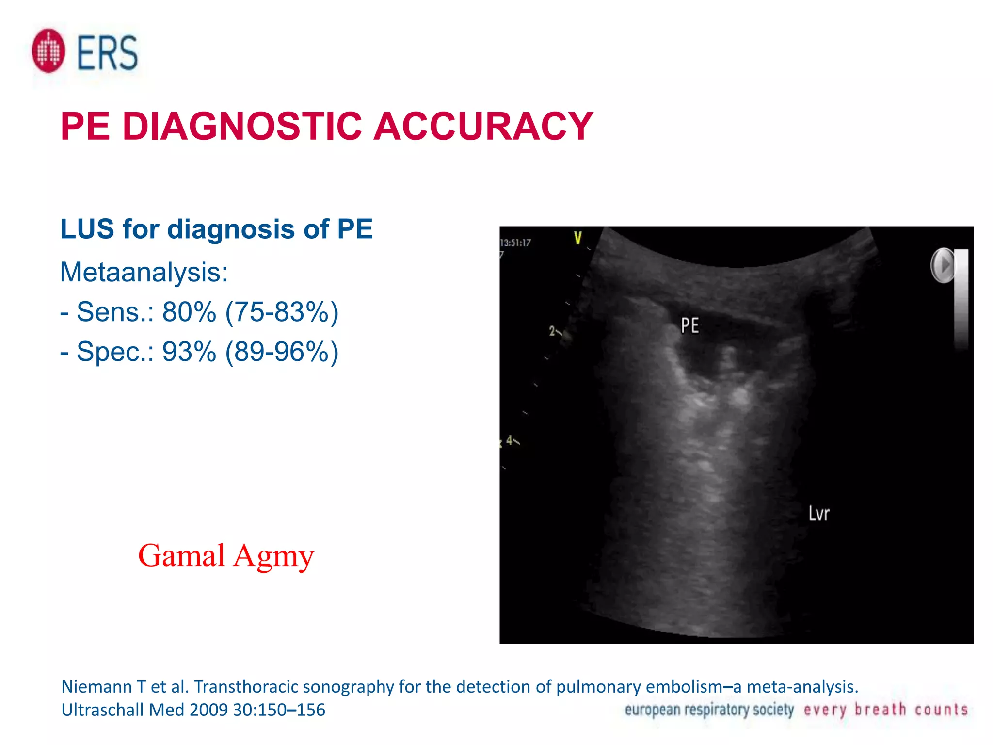 PE DIAGNOSTIC ACCURACY
LUS for diagnosis of PE
Metaanalysis:
- Sens.: 80% (75-83%)
- Spec.: 93% (89-96%)
Niemann T et al. Transthoracic sonography for the detection of pulmonary embolism–a meta-analysis.
Ultraschall Med 2009 30:150–156
Gamal Agmy
 