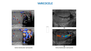 imaging of scrotum [Repaired] [Repaired].pptx