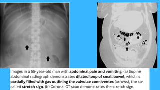 Valvulae Radiological Imaging of Small-Bowel Obstruction | PDF