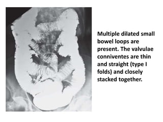 Valvulae Imaging of small bowel pathology | PPTX