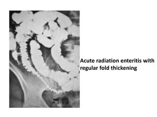 Imaging of small bowel pathology | PPTX