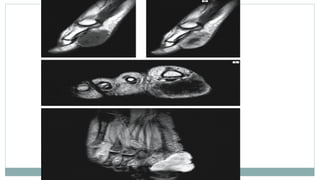 Imaging and Diagnosis of Soft Tissue Tumors | PPTX