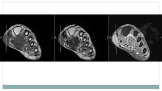 Imaging and Diagnosis of Soft Tissue Tumors | PPTX