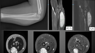 Imaging and Diagnosis of Soft Tissue Tumors | PPTX