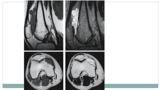 Imaging and Diagnosis of Soft Tissue Tumors | PPTX