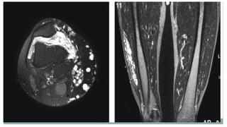 Imaging and Diagnosis of Soft Tissue Tumors | PPTX