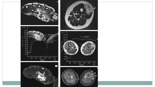 Imaging and Diagnosis of Soft Tissue Tumors | PPTX