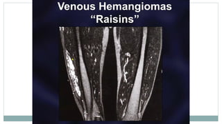 Imaging and Diagnosis of Soft Tissue Tumors | PPTX