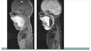 Imaging and Diagnosis of Soft Tissue Tumors | PPTX