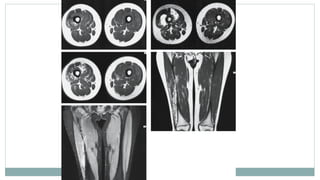 Imaging and Diagnosis of Soft Tissue Tumors | PPTX