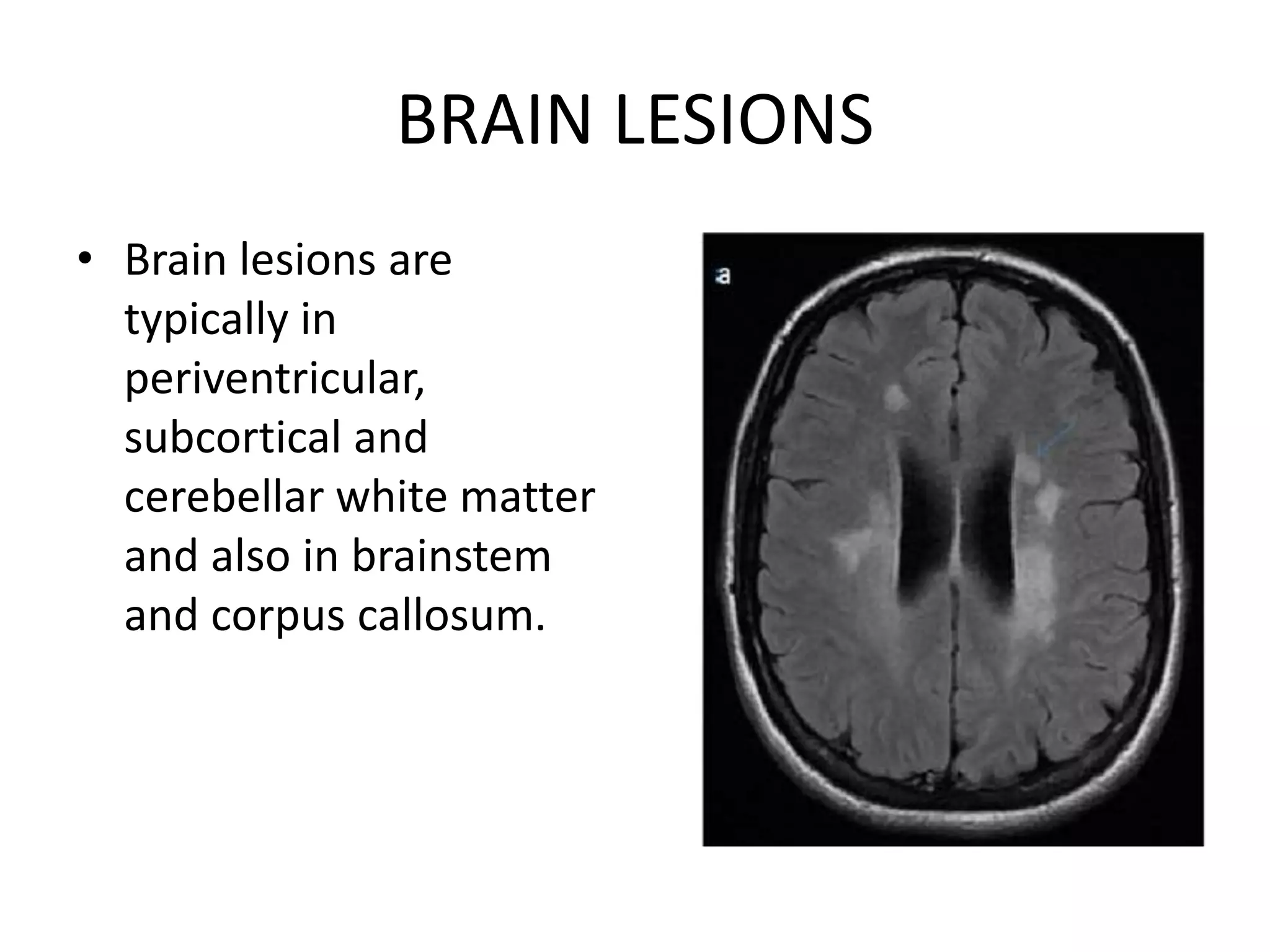 BRAIN LESIONS
• Brain lesions are
typically in
periventricular,
subcortical and
cerebellar white matter
and also in brainstem
and corpus callosum.
 