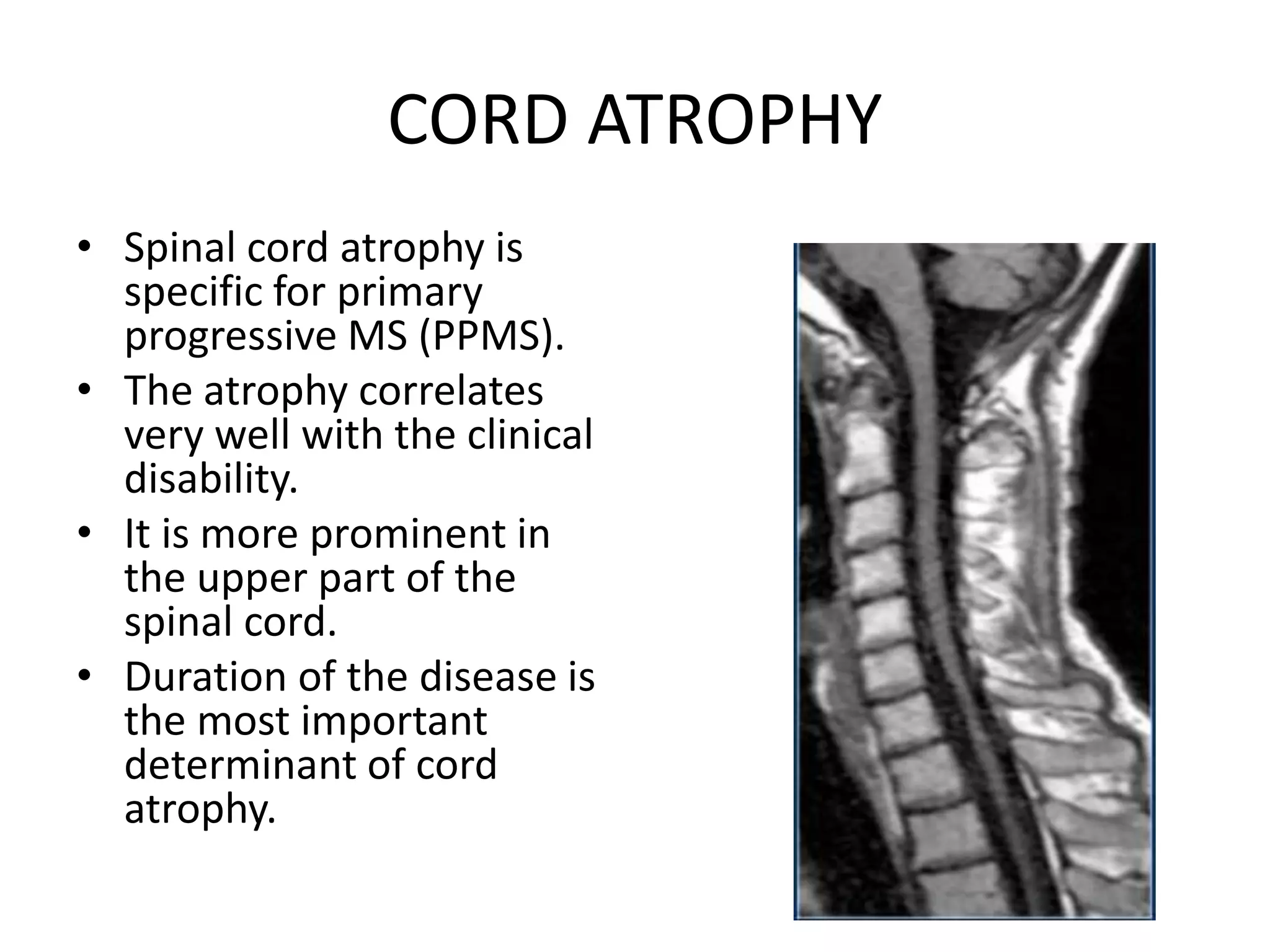 CORD ATROPHY
• Spinal cord atrophy is
specific for primary
progressive MS (PPMS).
• The atrophy correlates
very well with the clinical
disability.
• It is more prominent in
the upper part of the
spinal cord.
• Duration of the disease is
the most important
determinant of cord
atrophy.
 
