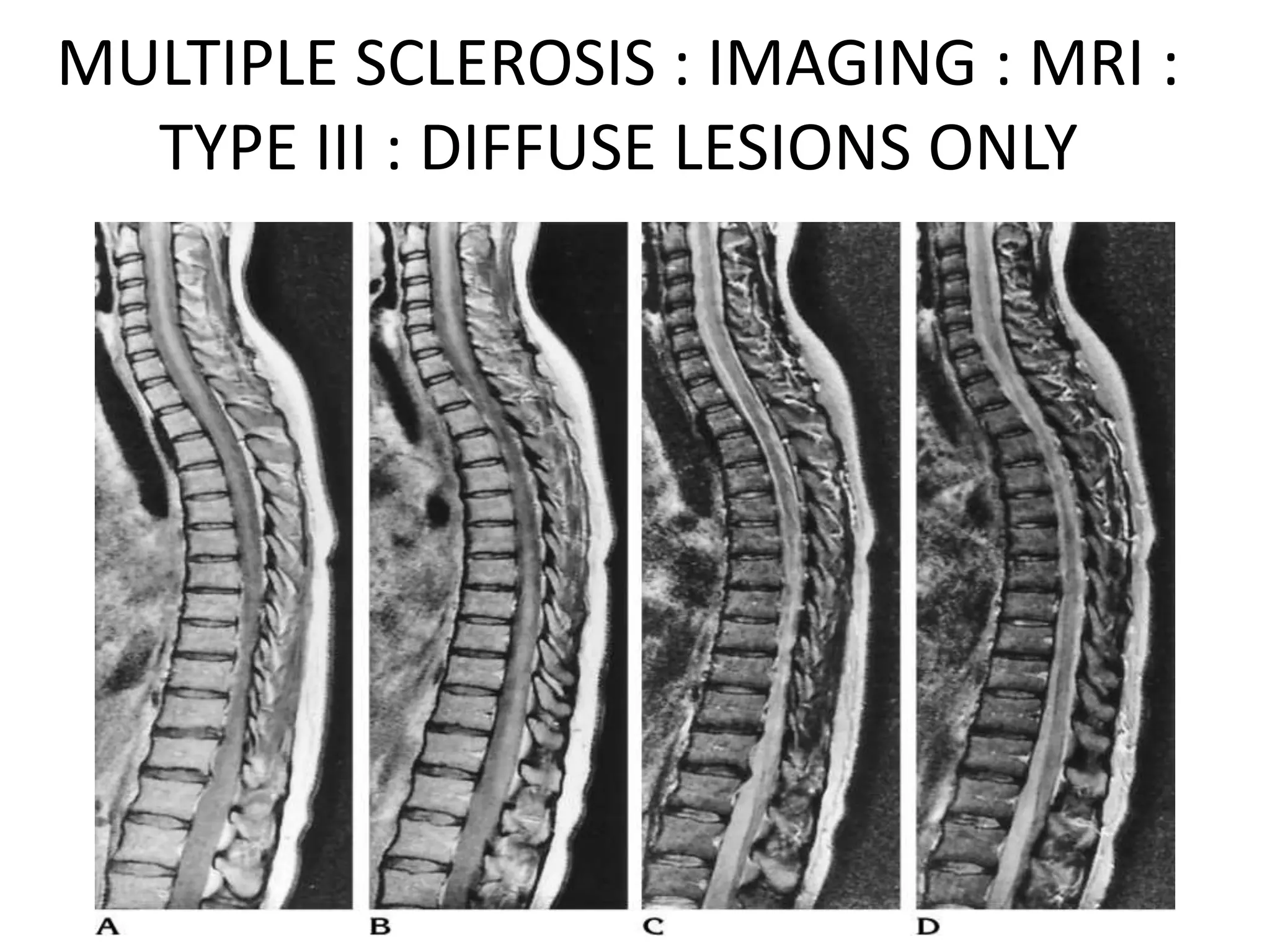 MULTIPLE SCLEROSIS : IMAGING : MRI :
TYPE III : DIFFUSE LESIONS ONLY
 