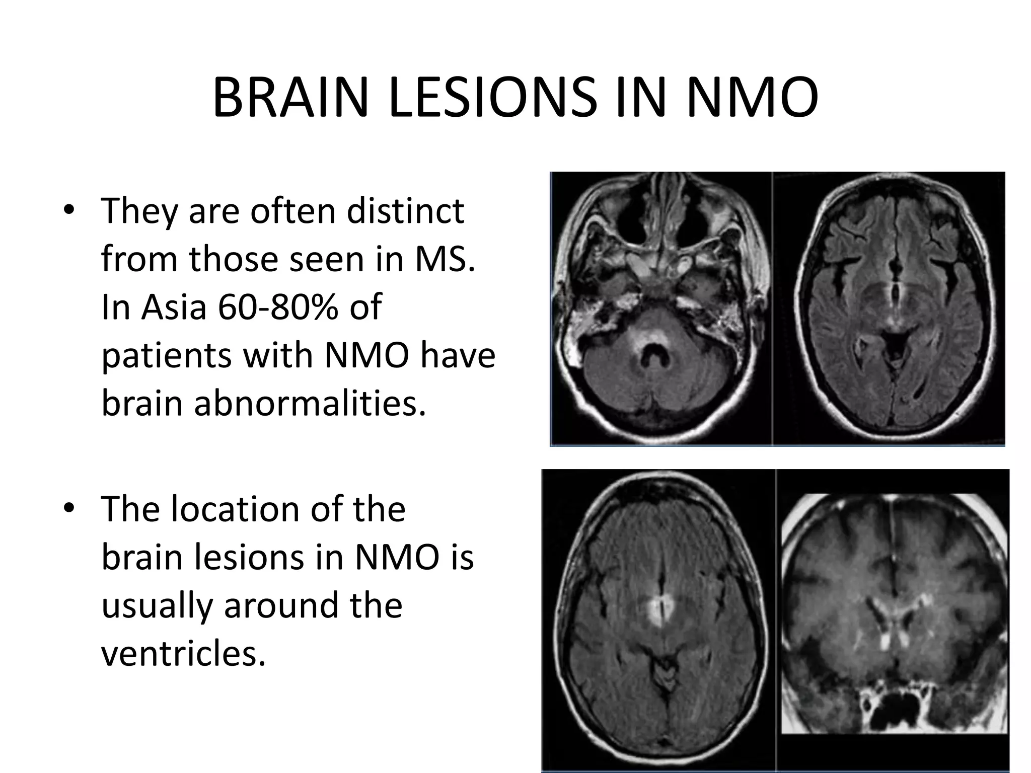 BRAIN LESIONS IN NMO
• They are often distinct
from those seen in MS.
In Asia 60-80% of
patients with NMO have
brain abnormalities.
• The location of the
brain lesions in NMO is
usually around the
ventricles.
 