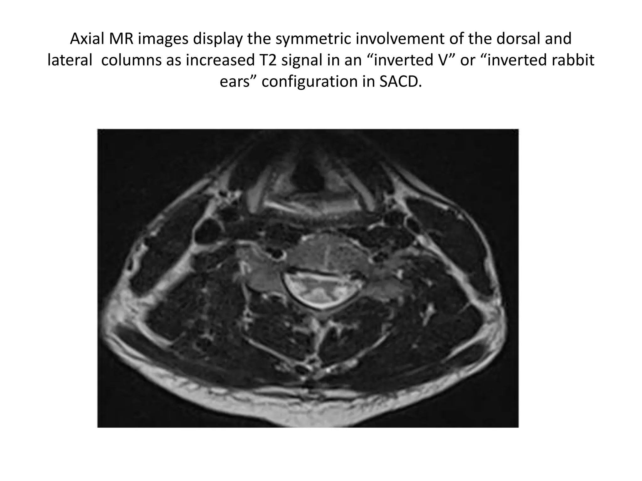 Axial MR images display the symmetric involvement of the dorsal and
lateral columns as increased T2 signal in an “inverted V” or “inverted rabbit
ears” configuration in SACD.
 