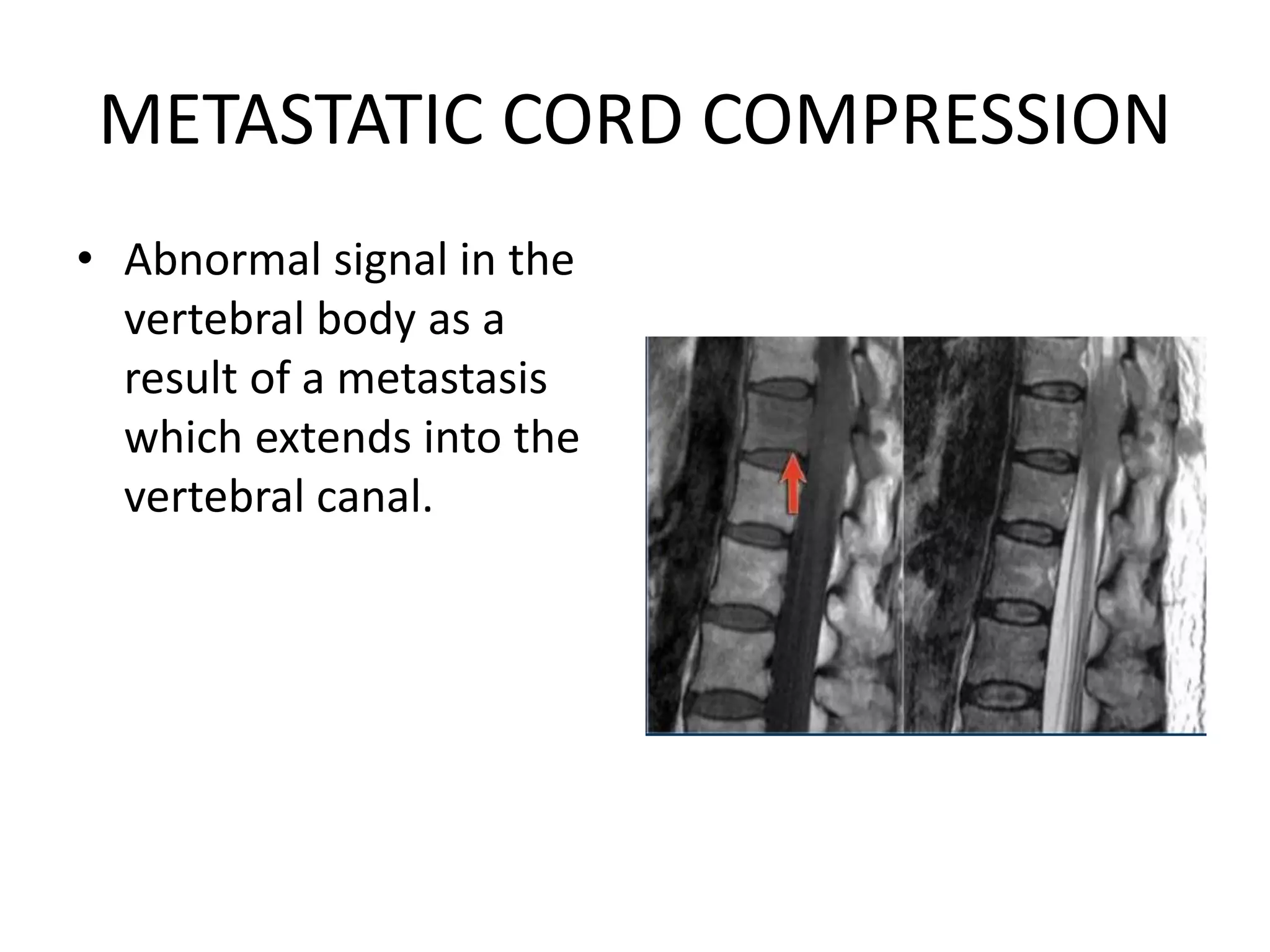 METASTATIC CORD COMPRESSION
• Abnormal signal in the
vertebral body as a
result of a metastasis
which extends into the
vertebral canal.
 