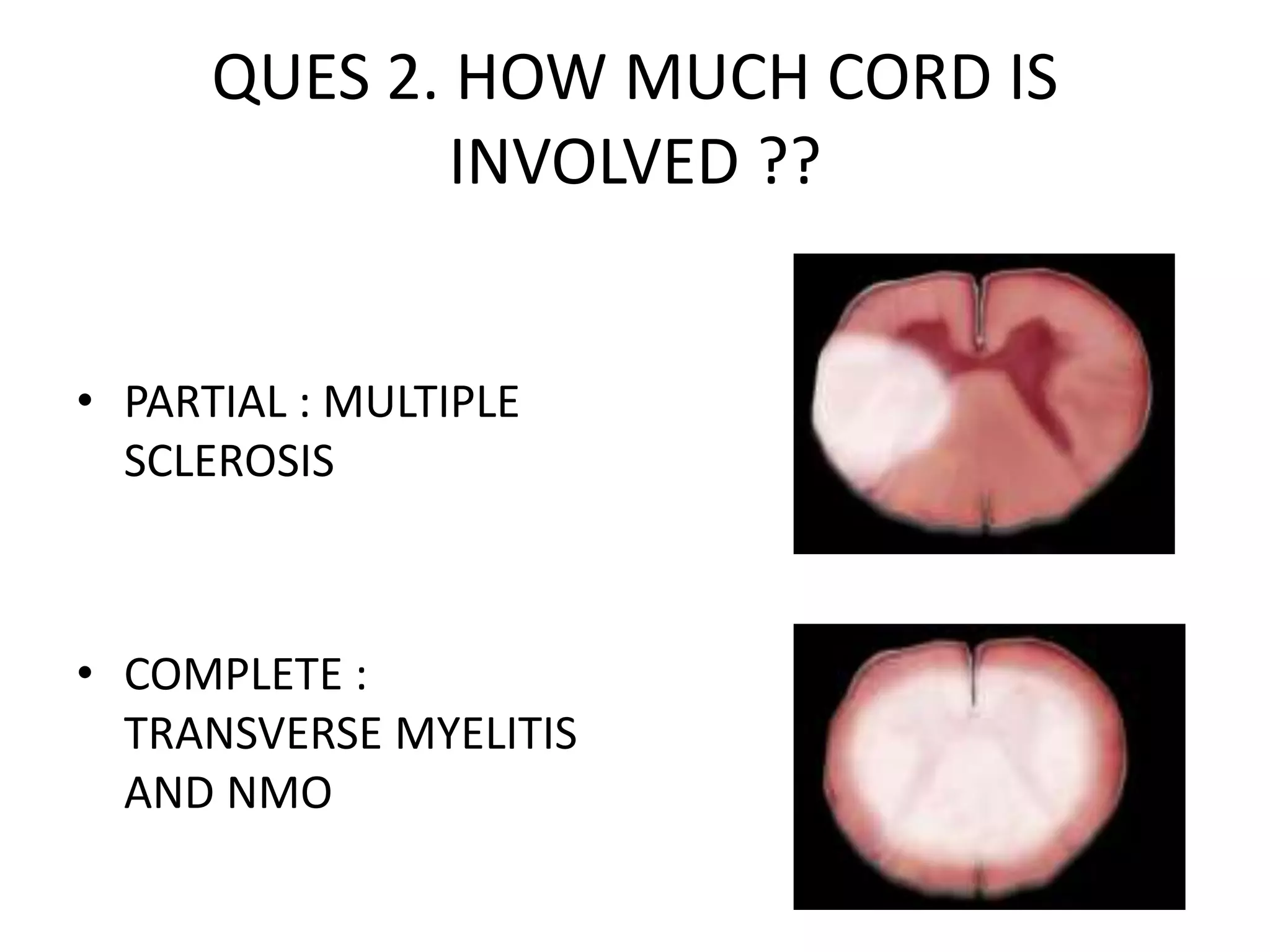QUES 2. HOW MUCH CORD IS
INVOLVED ??
• PARTIAL : MULTIPLE
SCLEROSIS
• COMPLETE :
TRANSVERSE MYELITIS
AND NMO
 