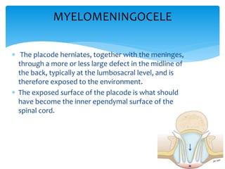  The placode herniates, together with the meninges,
through a more or less large defect in the midline of
the back, typically at the lumbosacral level, and is
therefore exposed to the environment.
 The exposed surface of the placode is what should
have become the inner ependymal surface of the
spinal cord.
MYELOMENINGOCELE
 