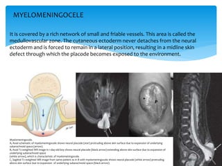 It is covered by a rich network of small and friable vessels. This area is called the
medullovascular zone. The cutaneous ectoderm never detaches from the neural
ectoderm and is forced to remain in a lateral position, resulting in a midline skin
defect through which the placode becomes exposed to the environment.
Myelomeningocele.
A, Axial schematic of myelomeningocele shows neural placode (star) protruding above skin surface due to expansion of underlying
subarachnoid space (arrow).
B, Axial T2-weighted MR image in 1-day-old boy shows neural placode (black arrow) extending above skin surface due to expansion of
underlying subarachnoid space
(white arrow), which is characteristic of myelomeningocele.
C, Sagittal T2-weighted MR image from same patient as in B with myelomeningocele shows neural placode (white arrow) protruding
above skin surface due to expansion of underlying subarachnoid space (black arrow).
MYELOMENINGOCELE
 