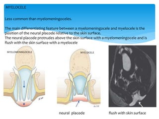 Less common than myelomeningoceles.
The main differentiating feature between a myelomeningocele and myelocele is the
position of the neural placode relative to the skin surface.
The neural placode protrudes above the skin surface with a myelomeningocele and is
flush with the skin surface with a myelocele
MYELOCELE
MYELOMENINGOCELE MYELOCELE
neural placode flush with skin surface
 