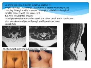 Lipomyelocele in a 7-month-old girl. a Sagittal T1-
weighted image shows large subcutaneous lipoma with fatty tissue
creeping through a wide posterior bony spina bifi da into the spinal
canal to connect with the spinal cord
b,c Axial T1-weighted images
show lipoma obliterates and expands the spinal canal, and is continuous
with subcutaneous lipoma through a wide posterior bony
spina bifida
The hairy tuft overlying subcutaneous lipomas
 