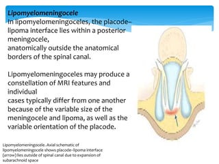 Lipomyelomeningocele. Axial schematic of
lipomyelomeningocele shows placode–lipoma interface
(arrow) lies outside of spinal canal due to expansion of
subarachnoid space
Lipomyelomeningocele
In lipomyelomeningoceles, the placode–
lipoma interface lies within a posterior
meningocele,
anatomically outside the anatomical
borders of the spinal canal.
Lipomyelomeningoceles may produce a
constellation of MRI features and
individual
cases typically differ from one another
because of the variable size of the
meningocele and lipoma, as well as the
variable orientation of the placode.
 