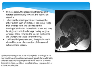 Lipomyelomeningocele. Axial T1-weighted MR image in 18-
month-old boy shows lipomyelomeningocele (arrow) that is
differentiated from lipomyelocele by location of placode–
lipoma interface outside of spinal canal due to expansion of
subarachnoid space.
• In most cases, the placode is stretched and
rotated eccentrically towards the lipoma on
one side
• whereas the meningocele develops on the
other side In such an instance, the spinal roots
that emerge from the side facing the
meningocele have a redundant course and may
be at greater risk for damage during surgery,
whereas those lying on the side of the lipoma
are shorter and cause cord tethering.
• Unlike with lipomyeloceles, the spinal canal is
dilated because of expansion of the ventral
subarachnoid spaces.
 