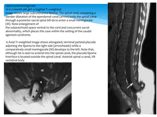 Lipomyelomeningocele
in a 2-month-old girl. a Sagittal T1-weighted
image shows large subcutaneous lipoma. The spinal cord, containing a
slender dilatation of the ependymal canal (arrow) exits the spinal canal
through a posterior sacral spina bifi da to enter a small meningocele
(M). Note enlargement of
the subarachnoid space ventral to the cord and concurrent sacral
abnormality, which places this case within the setting of the caudal
agenesis syndrome.
b Axial T1-weighted image shows elongated, terminal parietal placode
adjoining the lipoma to the right side (arrowheads) while a
comparatively small meningocele (M) develops to the left. Note that,
although fat is seen to extend into the spinal canal, the placode-lipoma
interface is located outside the spinal canal. Asterisk spinal a canal, VB
vertebral body
 