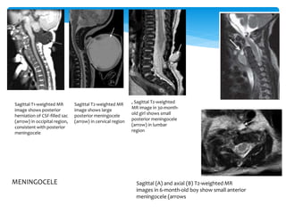 ,.
B,.
C.
Sagittal T1-weighted MR
image shows posterior
herniation of CSF-filled sac
(arrow) in occipital region,
consistent with posterior
meningocele
Sagittal T2-weighted MR
image shows large
posterior meningocele
(arrow) in cervical region
, Sagittal T2-weighted
MR image in 30-month-
old girl shows small
posterior meningocele
(arrow) in lumbar
region
Sagittal (A) and axial (B) T2-weighted MR
images in 6-month-old boy show small anterior
meningocele (arrows
MENINGOCELE
 