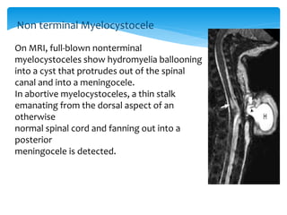 On MRI, full-blown nonterminal
myelocystoceles show hydromyelia ballooning
into a cyst that protrudes out of the spinal
canal and into a meningocele.
In abortive myelocystoceles, a thin stalk
emanating from the dorsal aspect of an
otherwise
normal spinal cord and fanning out into a
posterior
meningocele is detected.
Non terminal Myelocystocele
 