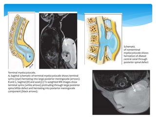 Terminal myelocystocele.
A, Sagittal schematic of terminal myelocystocele shows terminal
syrinx (star) herniating into large posterior meningocele (arrows).
B and C, Sagittal (B) and axial (C) T2-weighted MR images show
terminal syrinx (white arrows) protruding through large posterior
spina bifida defect and herniating into posterior meningocele
component (black arrows).
Schematic
of nonterminal
myelocystocele shows
herniation of dilated
central canal through
posterior spinal defect
 