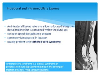  An intradural lipoma refers to a lipoma located along the
dorsal midline that is contained within the dural sac
 No open spinal dysraphism is present
 commonly lumbosacral in location
 usually present with tethered-cord syndrome
Tethered-cord syndrome is a clinical syndrome of
progressive neurologic abnormalities in the setting of
traction on a low-lying conus medullaris
Intradural and Intramedullary Lipoma
 