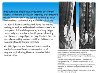 Intradural and intramedullary lipomas differ from
lipomas with dural defects in that they are contained
within an intact dural sac but are otherwise similar
to them both pathologically and embryologically.
Intradural lipomas are located along the midline
in the groove formed by the dorsal surface of the
unapposed folds of the placode, and may bulge
posteriorly in the subarachnoid spaces elevating
the pia mater. Large lipomas may displace the cord
laterally, resulting in an off-midline, flattened or
bumped placode–lipoma interface
Intradural lipoma in a 4-month-old girl. a Sagittal T1-weighted
image shows large lipoma fi lling the bottom of
the thecal sac and connecting to a low-lying spinal cord
(arrow). Note that there also is overgrowing subcutaneous
tissue.
This case could superfi cially resemble a lipomyelocele
(compare with Fig. 1.7); however, note continuity of the
superfi cial
fascia (arrowheads) separating the subcutaneous from the
intraspinal fat. b Coronal T1-weighted image shows the
lipoma
prevailingly develops to the right and connects to the right
side of the conus tip (arrow).
On MRI, lipomas are detected as masses that
are isointense with subcutaneous fat on all
sequences, including those acquired with fat
suppression
 