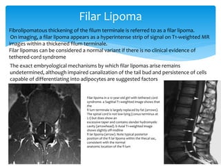 Filar Lipoma
Fibrolipomatous thickening of the filum terminale is referred to as a filar lipoma.
On imaging, a filar lipoma appears as a hyperintense strip of signal on T1-weighted MR
images within a thickened filum terminale.
Filar lipomas can be considered a normal variant if there is no clinical evidence of
tethered-cord syndrome
The exact embryological mechanisms by which filar lipomas arise remains
undetermined, although impaired canalization of the tail bud and persistence of cells
capable of differentiating into adipocytes are suggested factors
Filar lipoma in a 12-year-old girl with tethered cord
syndrome. a Sagittal T1-weighted image shows that
the
fi lum terminale is largely replaced by fat (arrows).
The spinal cord is not low-lying (conus terminus at
L1) but does show an
excessive taper and contains slender hydromyelic
cavity (arrowhead). b Axial T1-weighted image
shows slightly off-midline
fi lar lipoma (arrow). Note typical posterior
position of the fi lar lipoma within the thecal sac,
consistent with the normal
anatomic location of the fi lum
 