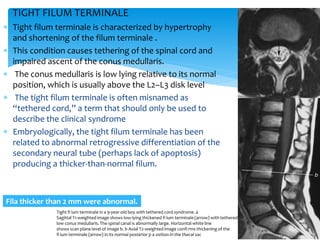 TIGHT FILUM TERMINALE
 Tight filum terminale is characterized by hypertrophy
and shortening of the filum terminale .
 This condition causes tethering of the spinal cord and
impaired ascent of the conus medullaris.
 The conus medullaris is low lying relative to its normal
position, which is usually above the L2–L3 disk level
 The tight filum terminale is often misnamed as
“tethered cord,” a term that should only be used to
describe the clinical syndrome
 Embryologically, the tight filum terminale has been
related to abnormal retrogressive differentiation of the
secondary neural tube (perhaps lack of apoptosis)
producing a thicker-than-normal filum.
Fila thicker than 2 mm were abnormal.
Tight fi lum terminale in a 9-year-old boy with tethered cord syndrome. a
Sagittal T1-weighted image shows low-lying thickened fi lum terminale (arrow) with tethered,
low conus medullaris. The spinal canal is abnormally large. Horizontal white line
shows scan plane level of image b. b Axial T2-weighted image confi rms thickening of the
fi lum terminale (arrow) in its normal posterior p a osition in the thecal sac
 