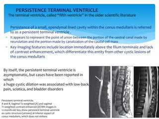 PERSISTENCE TERMINAL VENTRICLE
 Persistence of a small, ependymal lined cavity within the conus medullaris is referred
to as a persistent terminal ventricle .
 It appears to represent the point of union between the portion of the central canal made by
neurulation and the portion made by canalization of the caudal cell mass
 Key imaging features include location immediately above the filum terminale and lack
of contrast enhancement, which differentiate this entity from other cystic lesions of
the conus medullaris
Persistent terminal ventricle.
A and B, Sagittal T2-weighted (A) and sagittal
T1-weighted contrast-enhanced (B) MR images in
12-month-old boy show persistent terminal ventricle
as cystic structure (arrows) at inferior aspect of
conus medullaris, which does not enhanc
By itself, the persistent terminal ventricle is
asymptomatic, but cases have been reported in
which
a huge cystic dilation was associated with low-back
pain, sciatica, and bladder disorders
The terminal ventricle, called “fifth ventricle” in the older scientific literature
 