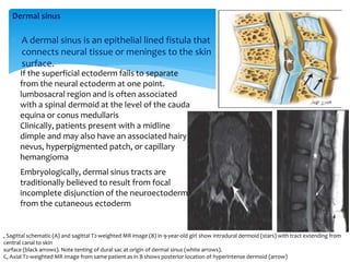 A dermal sinus is an epithelial lined fistula that
connects neural tissue or meninges to the skin
surface.
, Sagittal schematic (A) and sagittal T2-weighted MR image (B) in 9-year-old girl show intradural dermoid (stars) with tract extending from
central canal to skin
surface (black arrows). Note tenting of dural sac at origin of dermal sinus (white arrows).
C, Axial T2-weighted MR image from same patient as in B shows posterior location of hyperintense dermoid (arrow)
Embryologically, dermal sinus tracts are
traditionally believed to result from focal
incomplete disjunction of the neuroectoderm
from the cutaneous ectoderm
Dermal sinus
If the superficial ectoderm fails to separate
from the neural ectoderm at one point.
lumbosacral region and is often associated
with a spinal dermoid at the level of the cauda
equina or conus medullaris
Clinically, patients present with a midline
dimple and may also have an associated hairy
nevus, hyperpigmented patch, or capillary
hemangioma
 