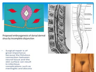 Proposed embryogenesis of dorsal dermal
sinus by incomplete disjunction
 