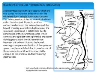 Midline integration is the process by which the
two paired notochordal anlagen fuse in the
midline to form a single notochordal process.
The full expression of the abnormality is the so-
called dorsal enteric fistula, in which a
connection between the skin surface and the
bowel, crossing a complete duplication of the
spine and spinal cord, is established due to
persistence of the neurenteric canal, which
connects the epiblast to the primitive endoderm
during gastrulation. which a connection
between the skin surface and the bowel,
crossing a complete duplication of the spine and
spinal cord, is established due to persistence of
the neurenteric canal, which connects the
epiblast to the primitive endoderm during
gastrulation.
Split notochord syndrome. Diagrammatic representation of developmental
posterior enteric remnants.
DISORDERS OF MIDLINE NOTOCHORDAL INTEGRATION
 