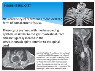 NEURENTERIC CYST
A and B, Sagittal T2-weighted (A) and axial
T1-weighted (B) MR images show bilobed
neurenteric cyst (arrows) extending from
central canal into posterior mediastinum.
C, Three-dimensional CT reconstruction
image shows osseous opening (arrow)
through which neurenteric cyst passes. This
opening is called the Kovalevsky canal
Neurenteric cysts represent a more localized
form of dorsal enteric fistula .
These cysts are lined with mucin-secreting
epithelium similar to the gastrointestinal tract
and are typically located in the
cervicothoracic spine anterior to the spinal
cord
 